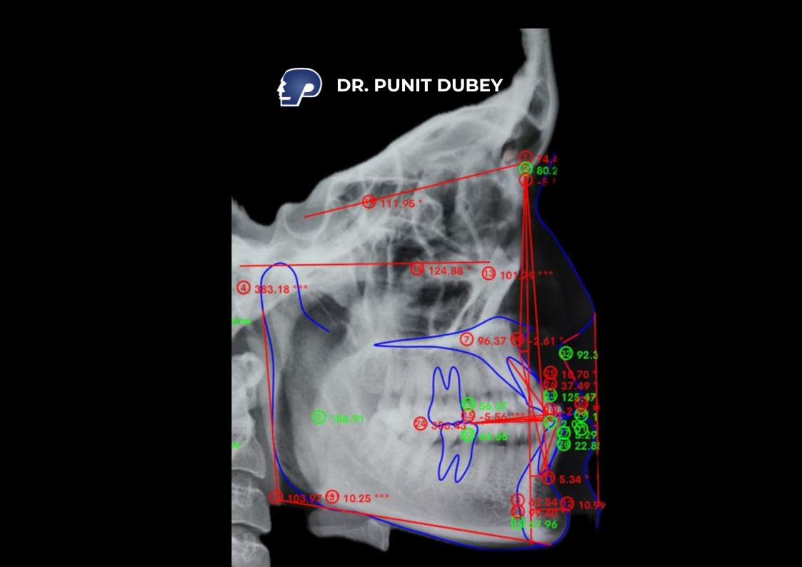 Genioplasty Surgery in Delhi by Dr. PUNIT DUBEY – From Consultation to Recovery