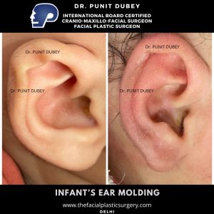 Ear Molding Before and After