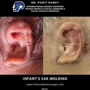 Ear Molding in India