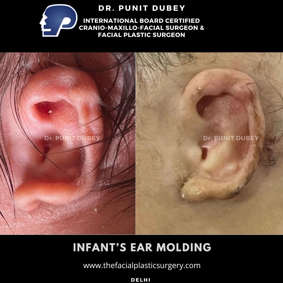 Before and After Infant Ear Molding in Delhi – Early Newborn Ear Correction Results in India