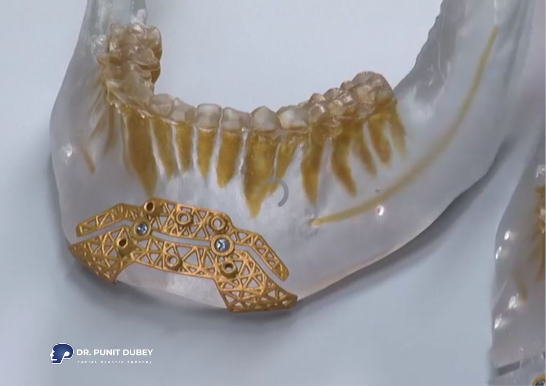 Genioplasty Cost in Delhi - Affordable Chin Augmentation Surgery