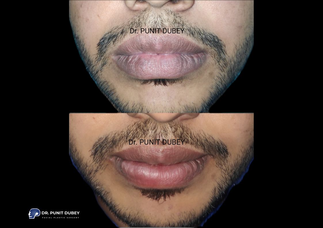 Before and After Lip Reduction Surgery - See the Enhanced Lip Shape and Proportional Balance