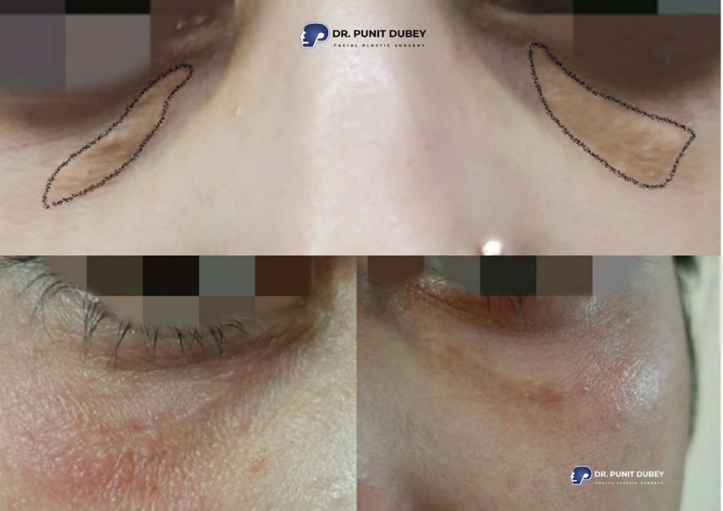 Xanthelasma Before and After