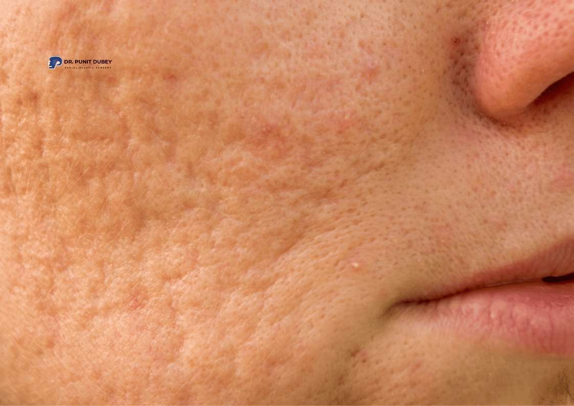 Effective Acne Scar Revision Surgery in Delhi by Dr. Punit Dubey