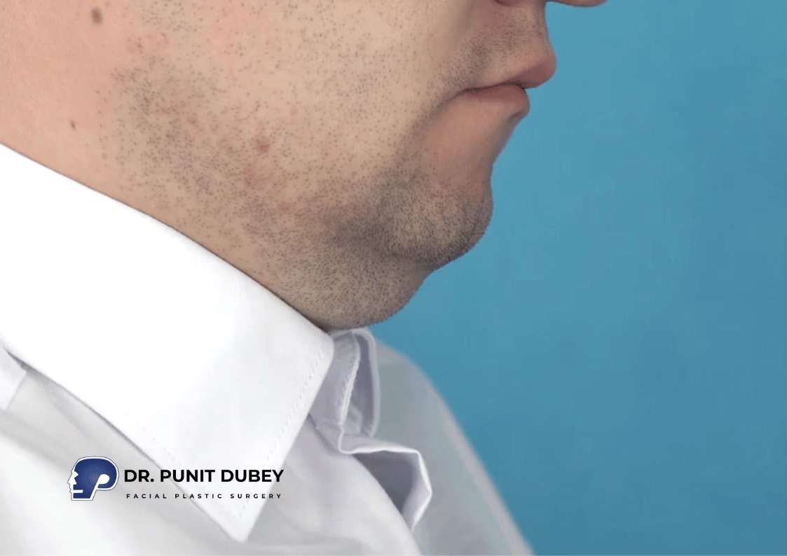 Deep Plane Neck Lift Surgery in Delhi for the first time by Dr. Punit Dubey – Advanced Neck Countering