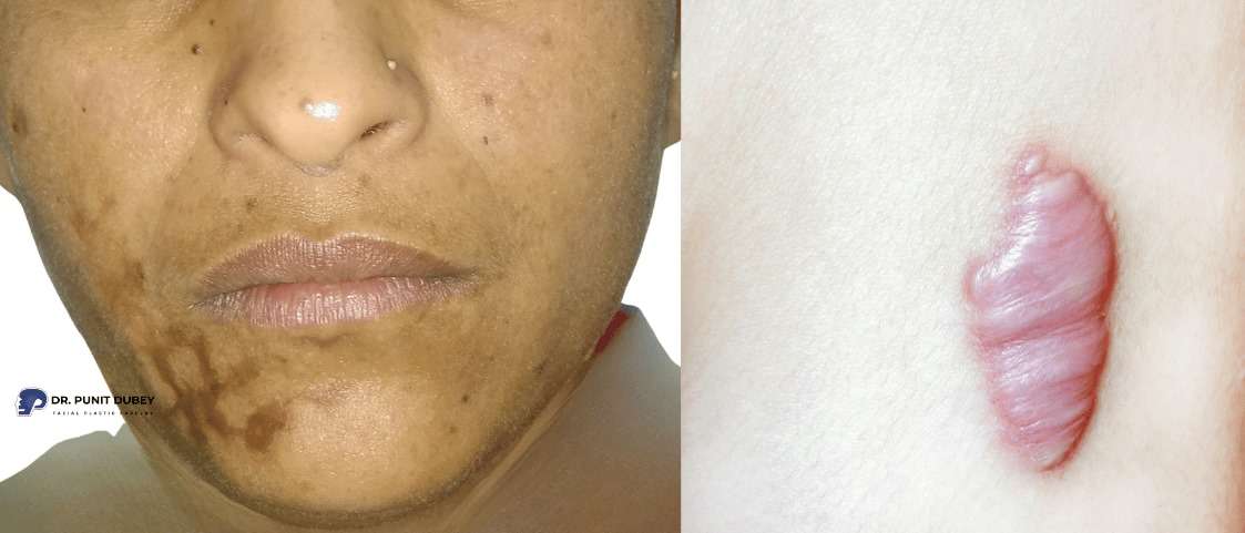 Face Scar Example Facial Scar Revision Surgery In Delhi