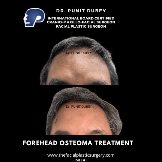 Forehead Osteoma Before and After by Dr. Punit Dubey – Visible Results of Safe Removal