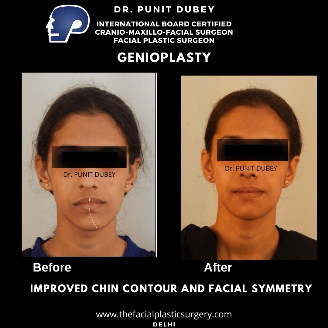 Chin Augmentation Before and After by Dr. PUNIT DUBEY– Improved Chin Contour and Facial Symmetry