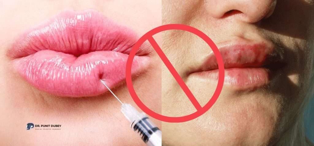 Lip Fillers Side Effects – Understanding Risks and Recovery in Delhi