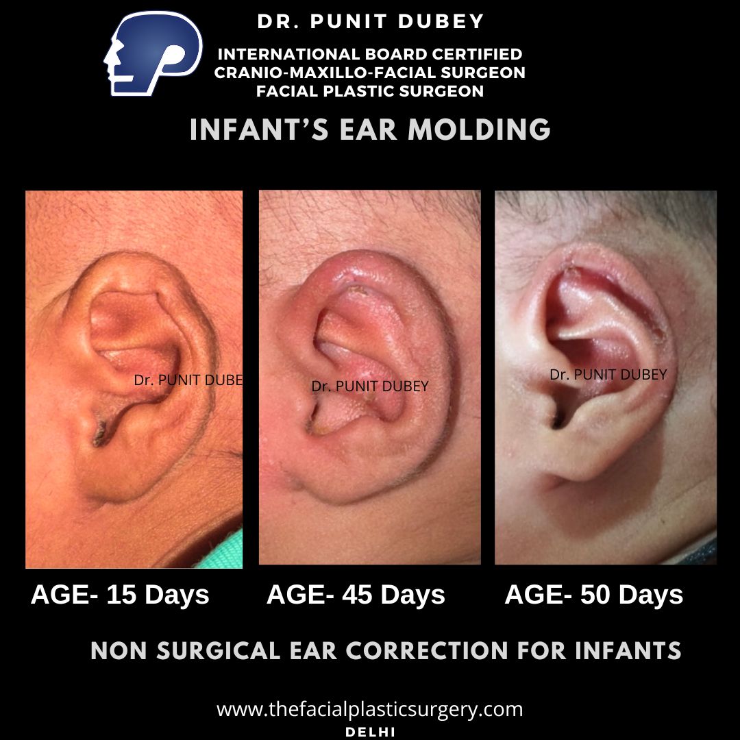 Otoplasty for Infants in India – Corrective Ear Surgery for Newborns