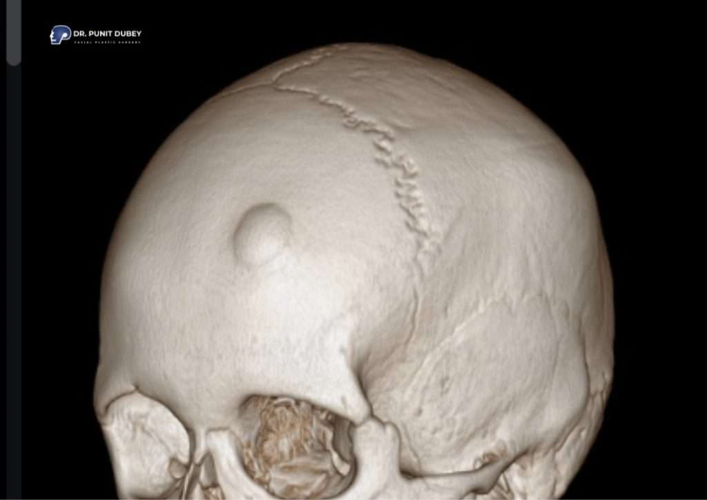 Osteoma Forehead Causes – Understanding Benign Bone Growth on the Forehead