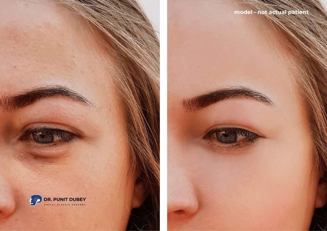 Under Eye Fillers Before and After – Dramatic Results for Dark Circles and Hollowness