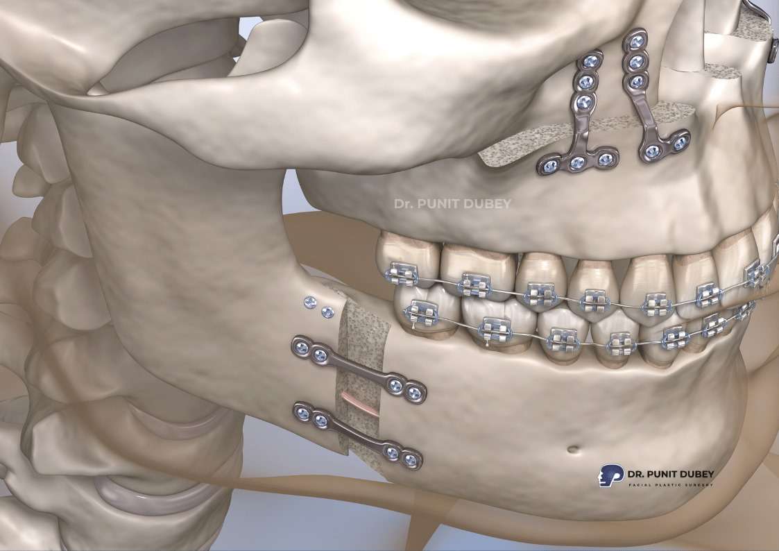 Double jaw surgery in India by Dr. Punit Dubey – Comprehensive upper and lower jaw correction.