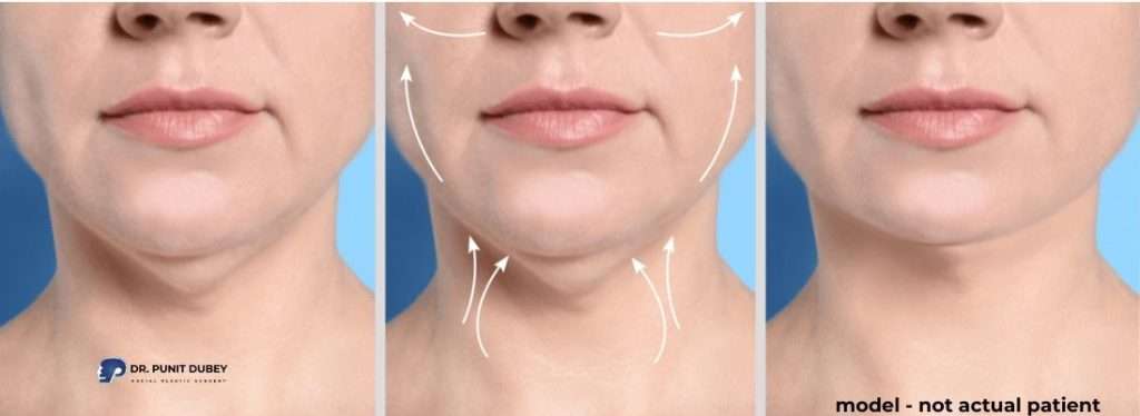 Facelift Surgery Before and After in India