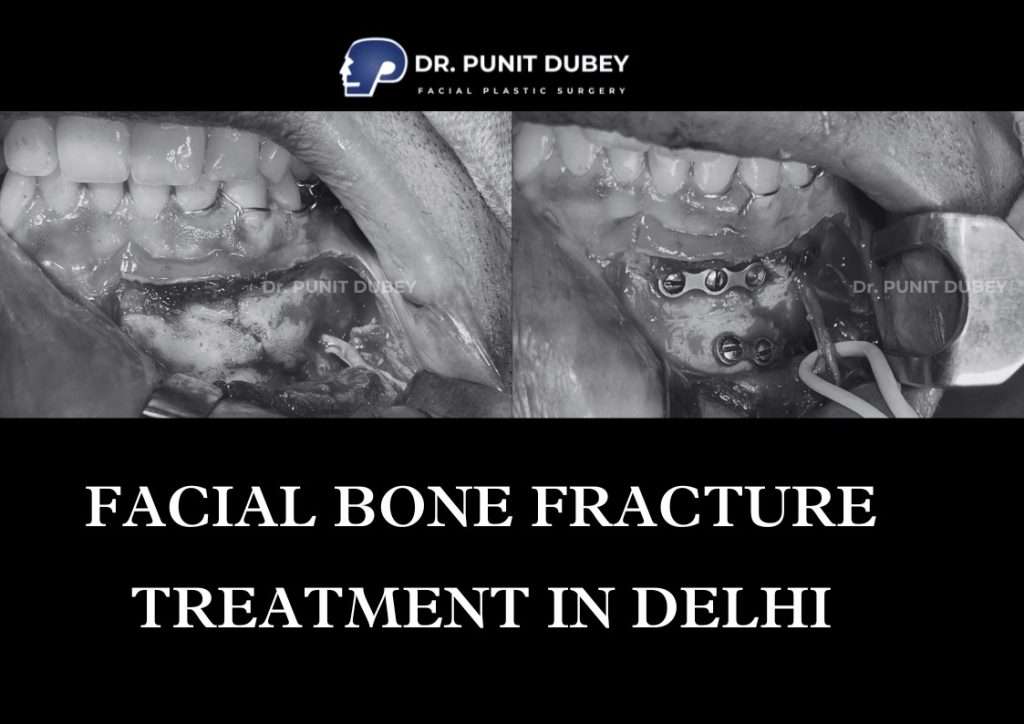 Facial Bone Fracture Treatment in Delhi by Dr. Punit Dubey – Expert Trauma Care.