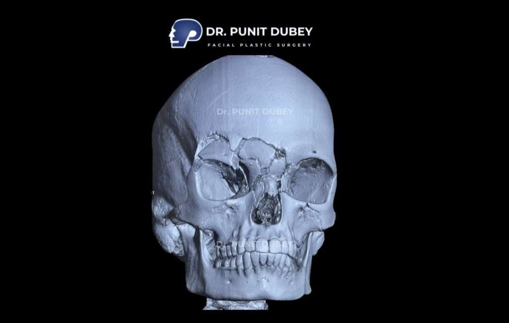 Facial Fracture Treatment Cost in Delhi – Affordable Expert Care by Dr. Punit Dubey.
