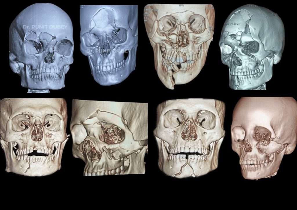 Facial Bone Fracture Treatment in Delhi – Maxillofacial Trauma Care by Dr. Punit Dubey.