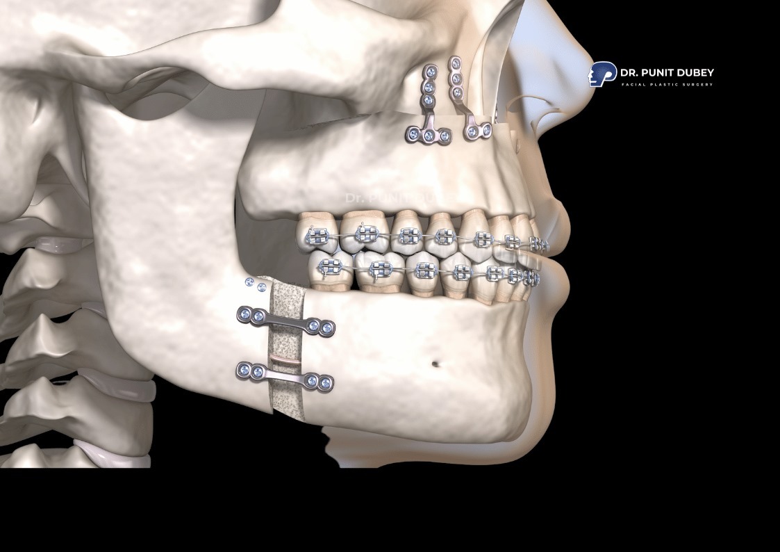 Jaw surgery in India by Dr. Punit Dubey – Advanced jaw correction and reshaping.