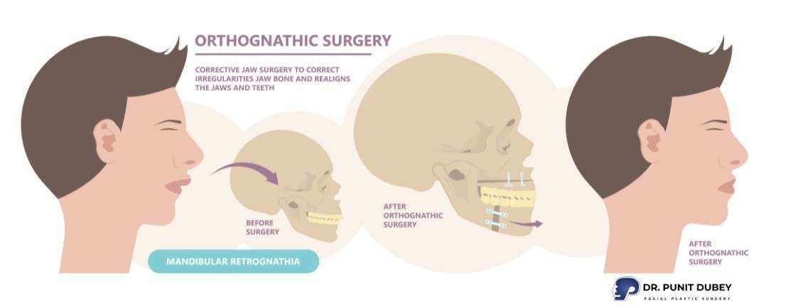 Lower jaw surgery in India by Dr. Punit Dubey - Underbite Jaw Surgery