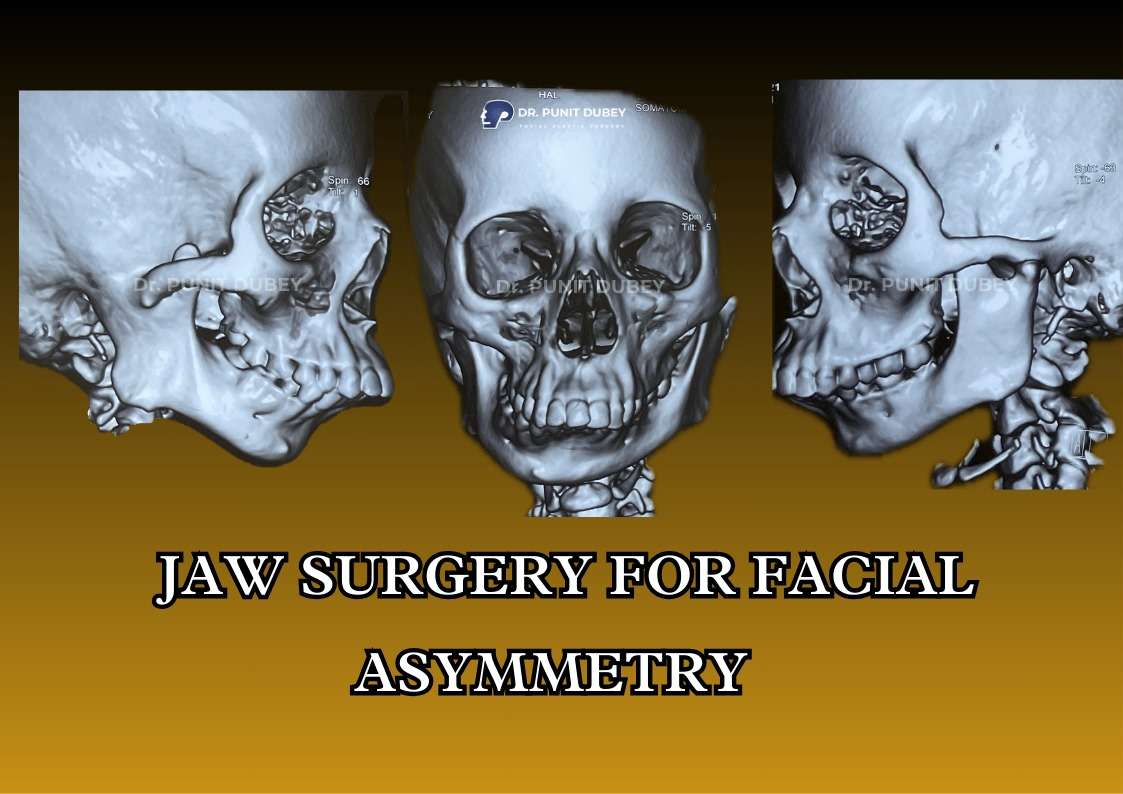 Jaw Asymmetry Surgery in India by Dr. Punit Dubey – Expert Orthognathic Surgery.