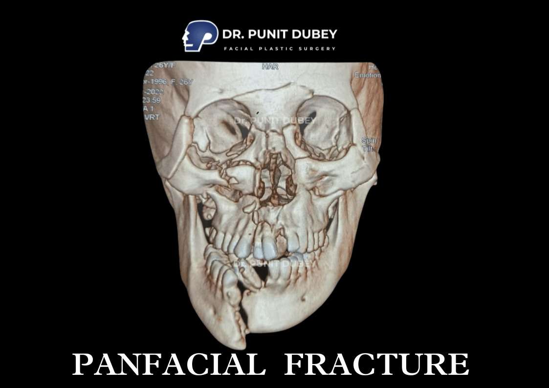 Pan facial fracture surgery in Delhi by Dr. Punit Dubey – expert care for complex facial trauma.