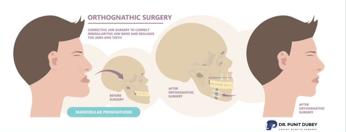 Upper Jaw Correction Surgery in India by Dr. Punit Dubey – Overbite jaw surgery
