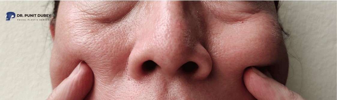 Ideal candidates for midface lift surgery in Delhi by Dr. Punit Dubey – rejuvenation for sagging cheeks.