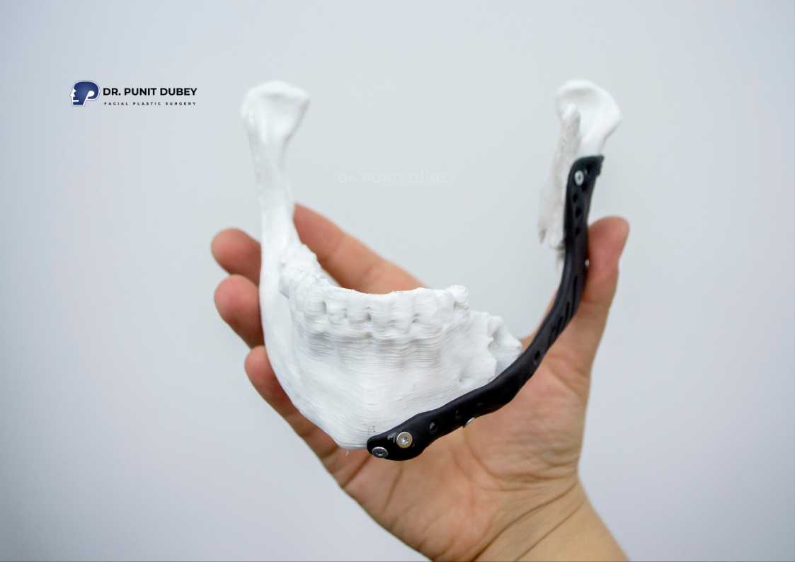 Custom jaw implant in Delhi by Dr. Punit Dubey – expert, tailored jaw augmentation.