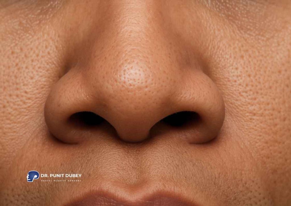 Alar base reduction in Delhi by Dr. Punit Dubey – flared nostril correction for balanced nasal width.