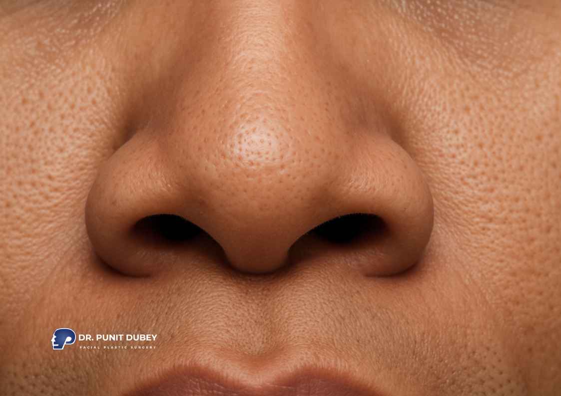 Alar base reduction in Delhi by Dr. Punit Dubey – flared nostril correction for balanced nasal width.