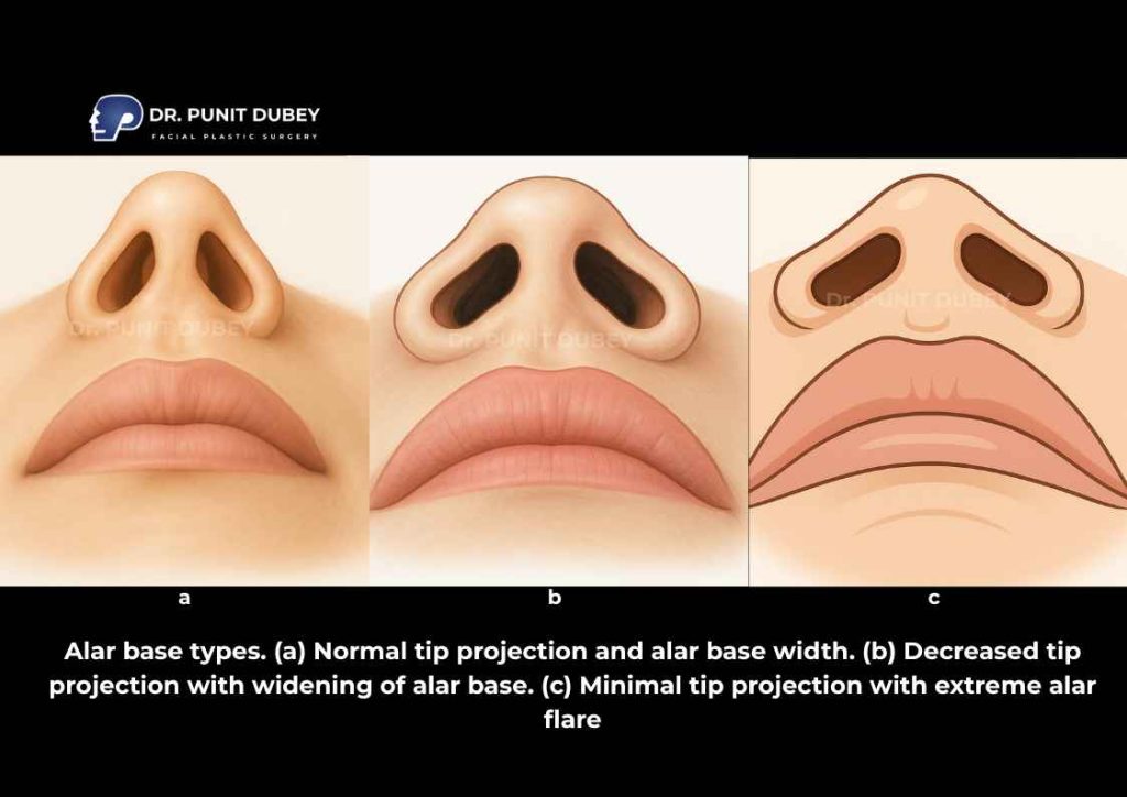Types of alar base – nasal base anatomy including wide, narrow, flared, and asymmetrical nostrils.