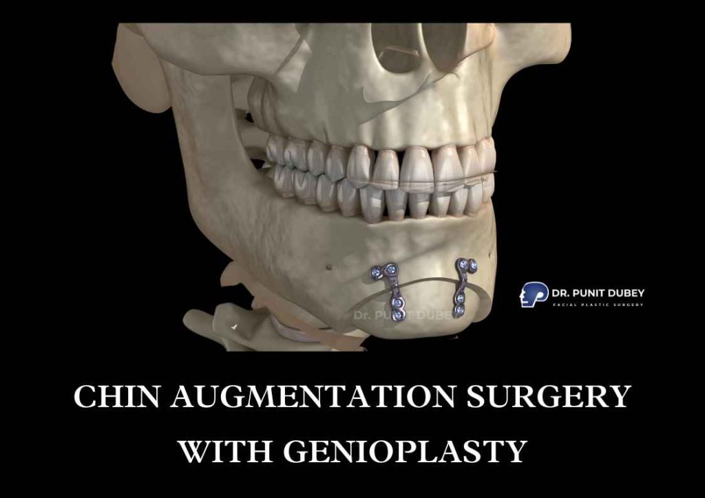 Chin Augmentation Surgery in India – Define Your Profile with Precision genioplasty or chin implants.
