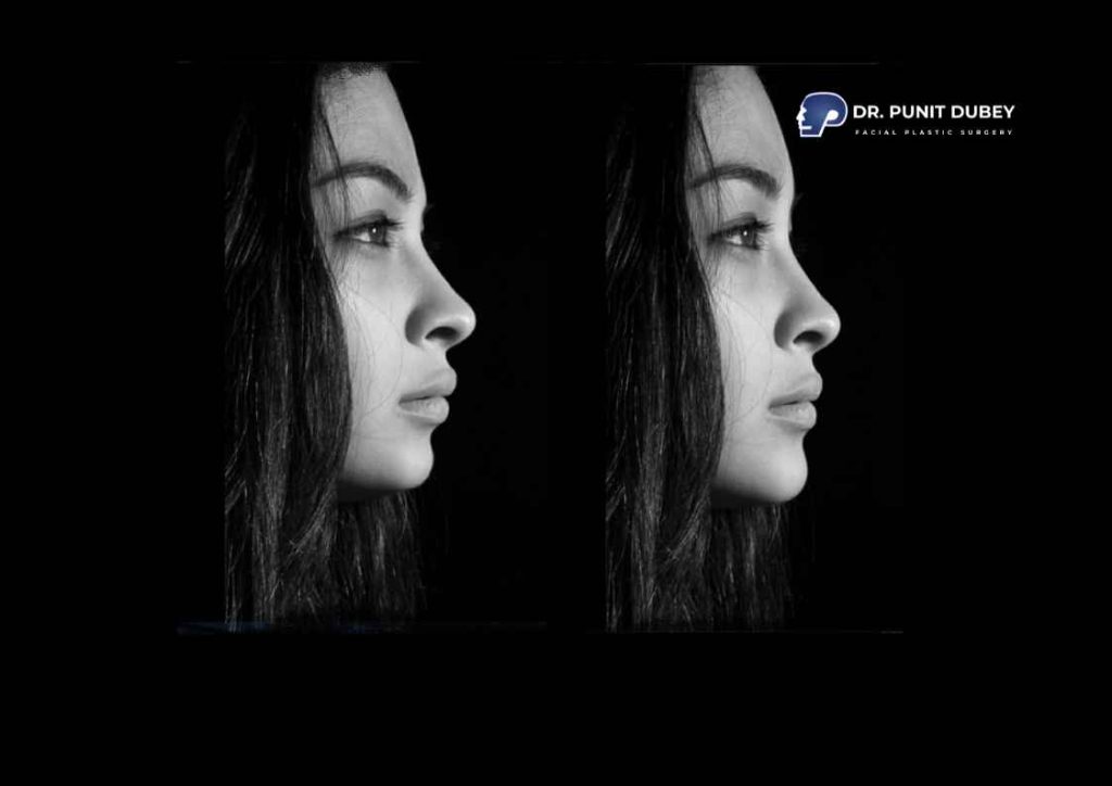 Expert Chin Augmentation in India - Improve facial symmetry and profile.