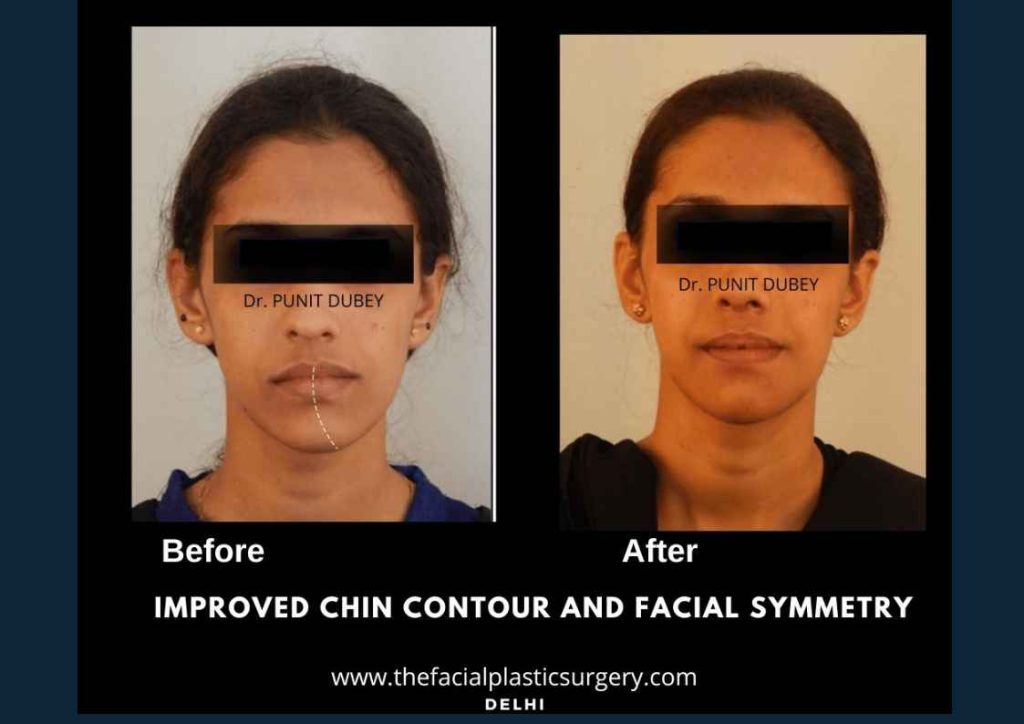 Facial Asymmetry Surgery Before and After – jaw and chin realignment by Dr. Punit Dubey.