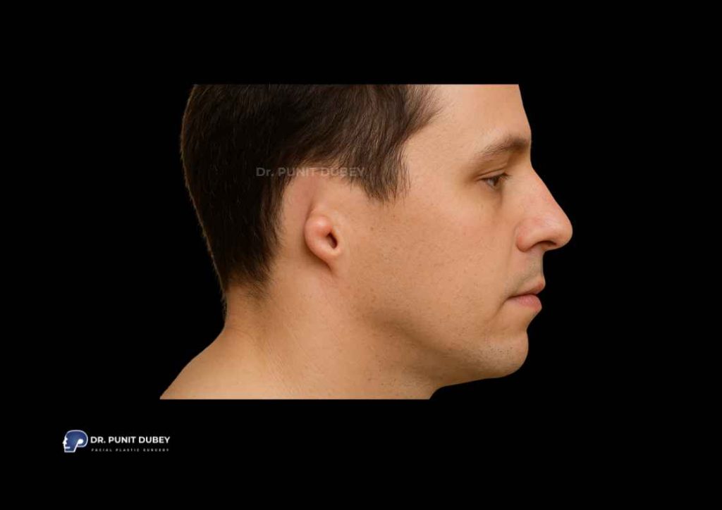 Microtia Surgery in India by Dr. Punit Dubey – Advanced Ear Reconstruction.