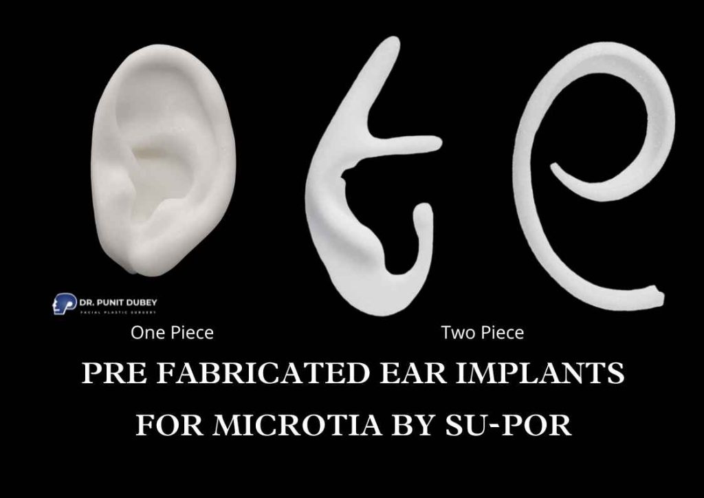 Auricular Implant-based microtia reconstruction in India – expert ear surgery without rib grafts.