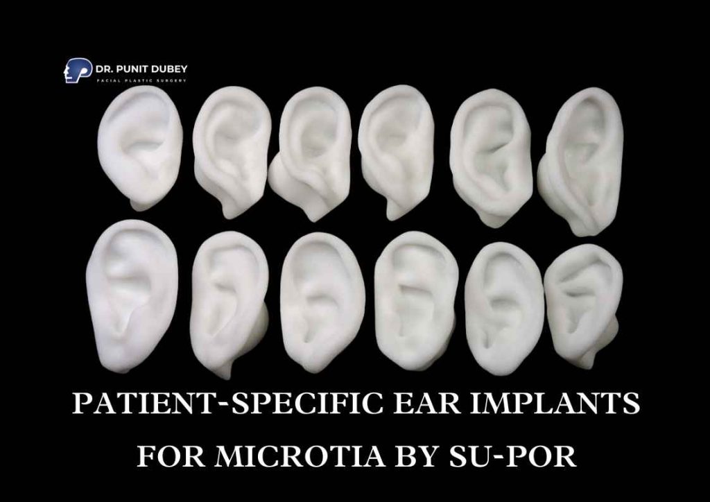 Patient specific 3D ear implants by Su-Por – custom ear reconstruction for microtia patients.