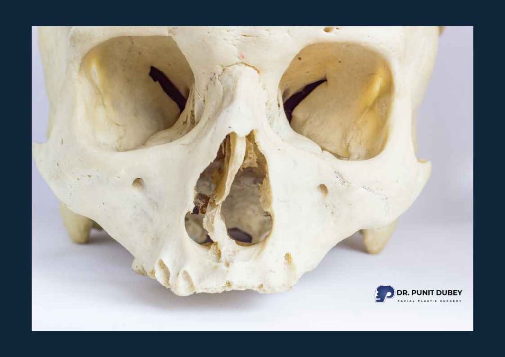 What Is a Deviated Nasal Septum? Causes, Symptoms & Surgical Correction.