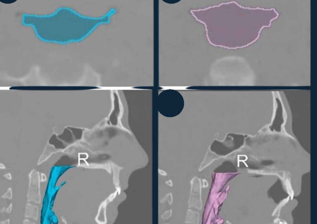 Benefits of double jaw surgery for sleep apnea – improved airway, better oxygen levels, reduced snoring.