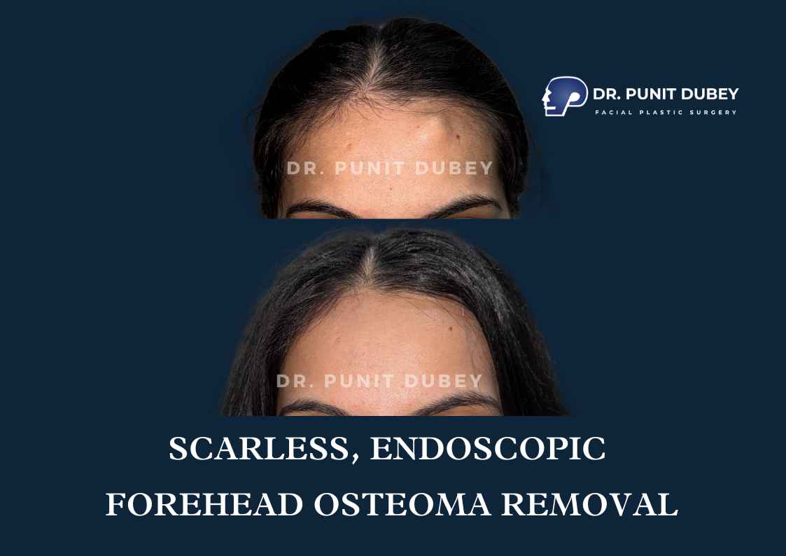 Before and after endoscopic osteoma removal in India – restored smooth forehead contour with no visible scar.