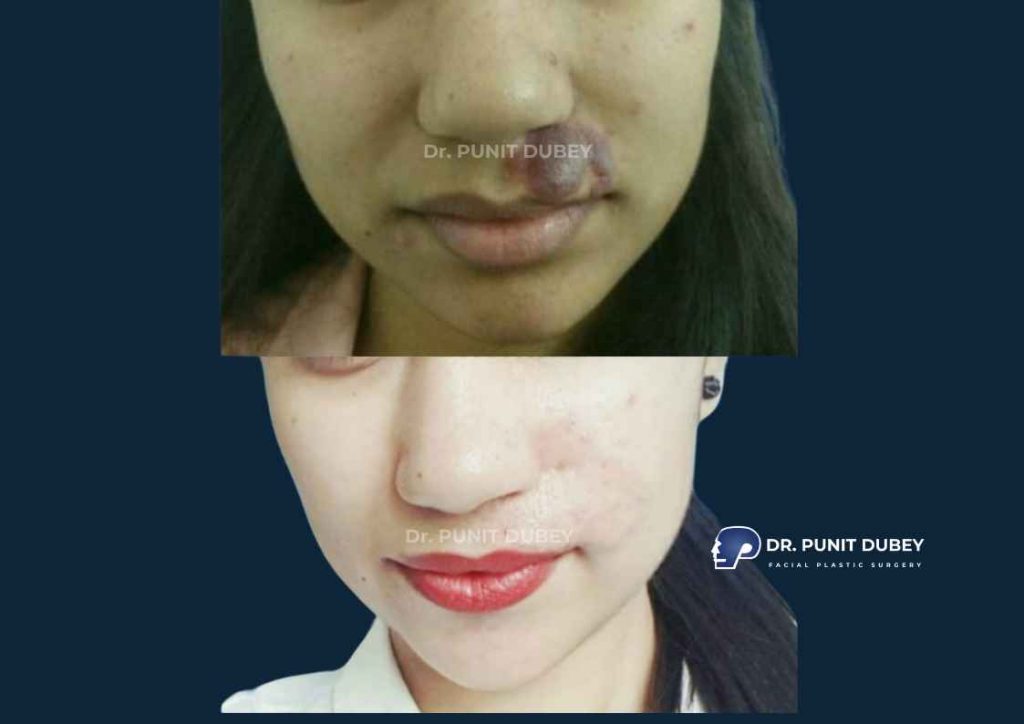 Facial Birthmark Removal Before and After in Delhi by Dr. Punit Dubey – Restore Clear, Even Skin Tone Safely.