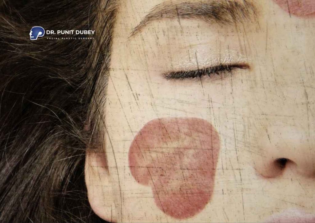 Facial Birthmark Removal in India – Safe & Effective Treatment by Dr. Punit Dubey.