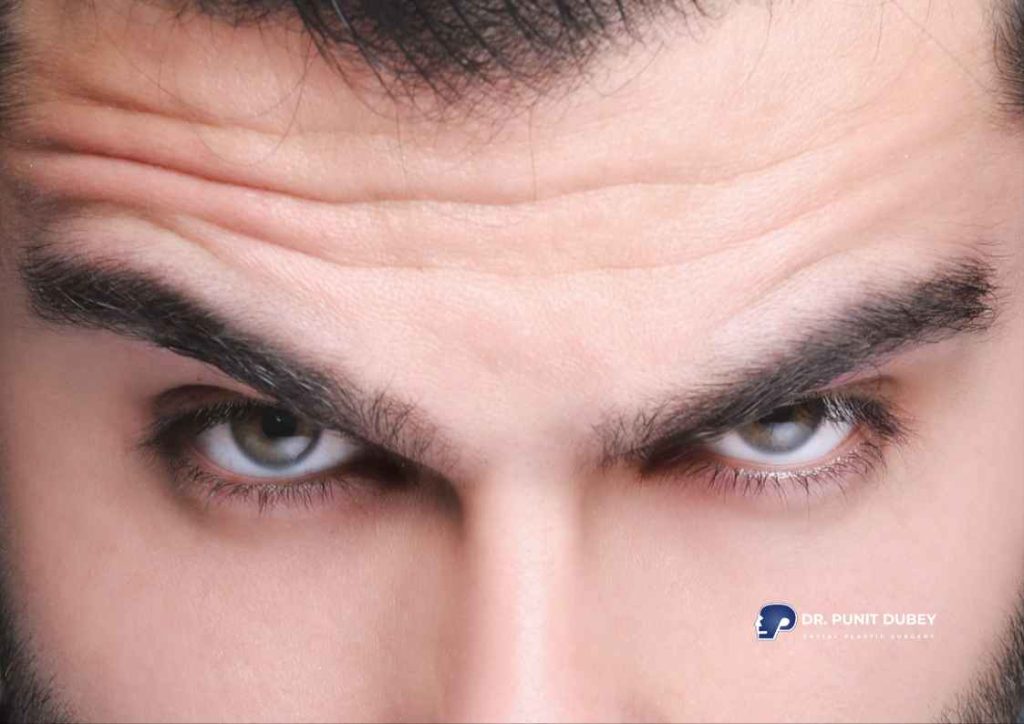 Forehead wrinkles treatment in India by Dr. Punit Dubey - Expert anti wrinkle injections