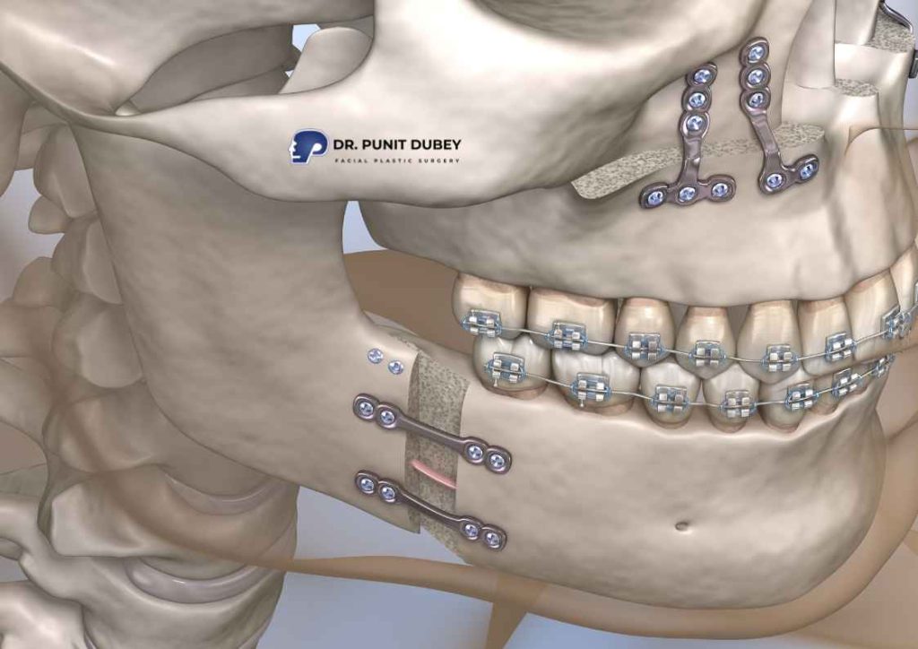Obstructive sleep apnea surgery cost in India – estimated price for MMA and airway surgeries.