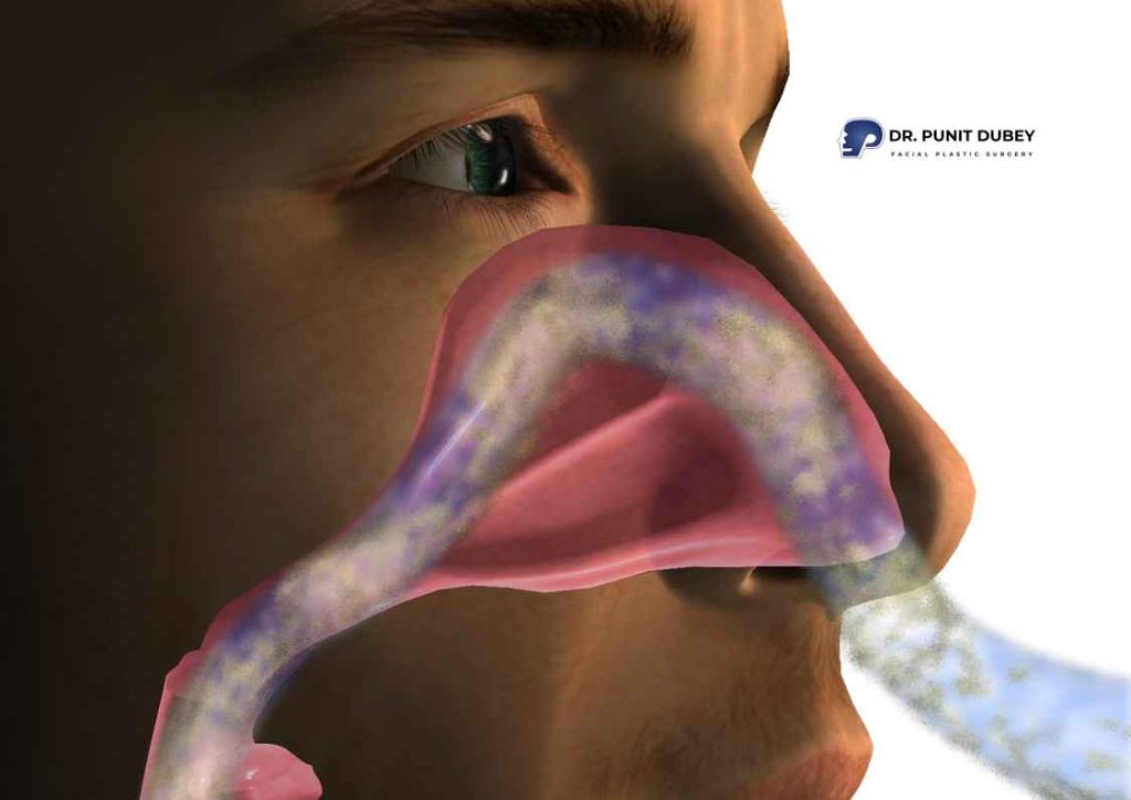 Benefits of septoplasty surgery in Delhi – improved nasal airflow, sinus relief, and better sleep quality.