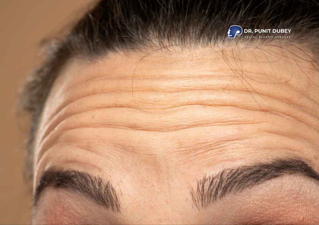 Forehead Lines – Causes, Types, and When to Consider Treatment.