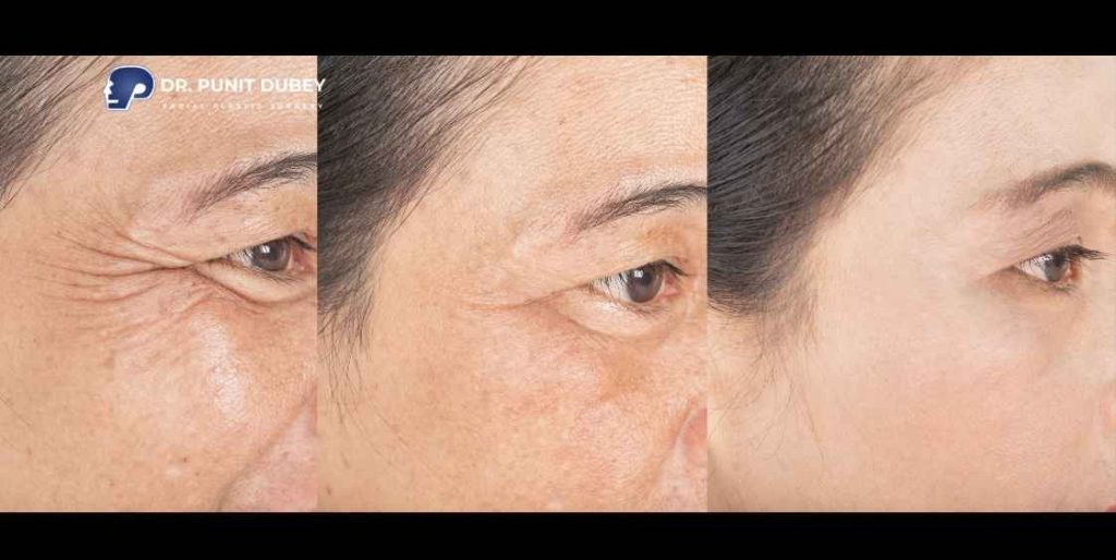 Wrinkle Treatment in India by Dr. Punit Dubey.