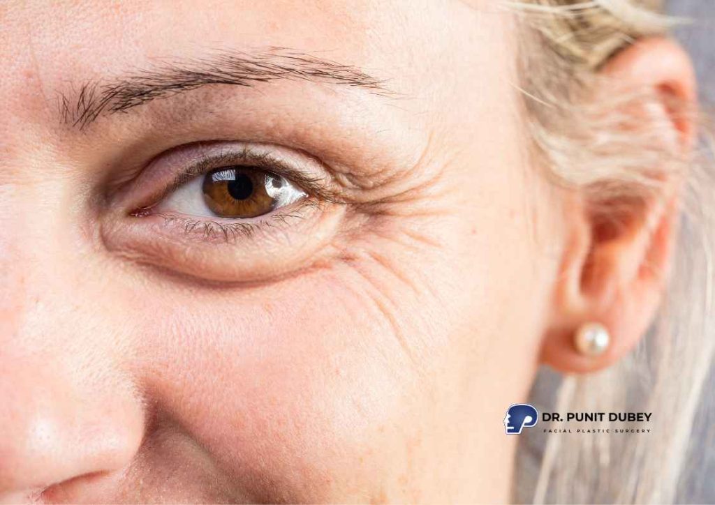 Wrinkles on face – causes of facial lines and common treatment options.