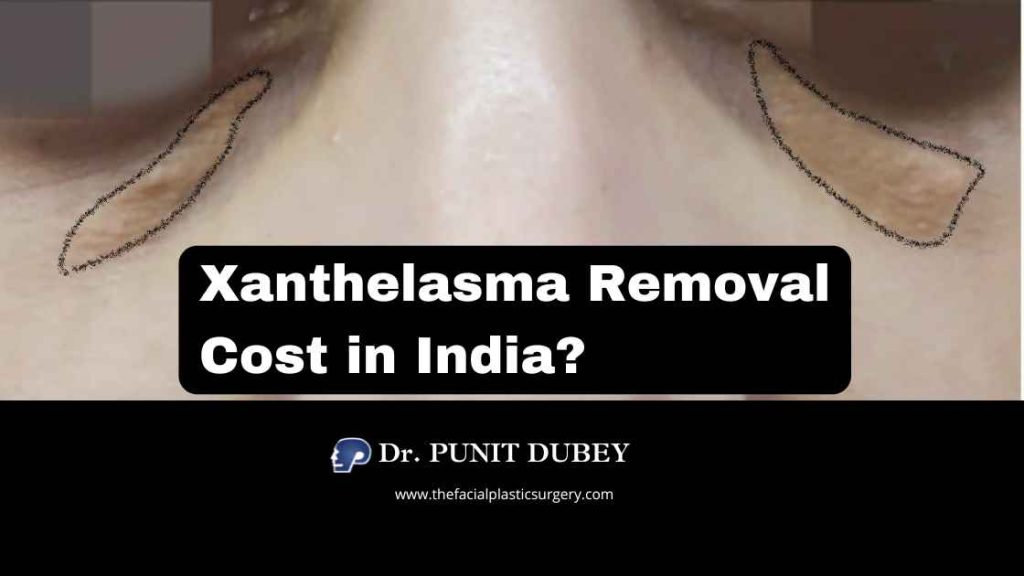 Affordable xanthelasma Surgery cost in Delhi by Dr. Punit Dubey 2025.