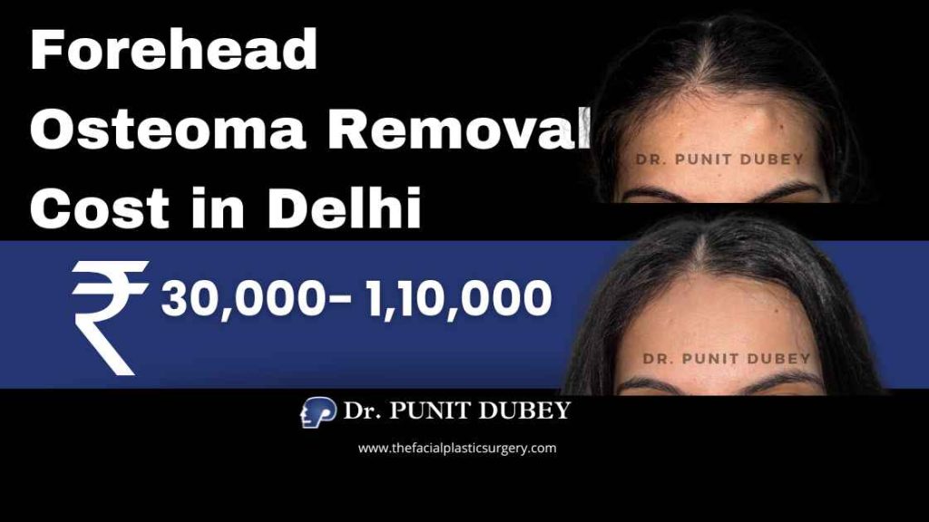 Endoscopic & Traditional Forehead Osteoma Removal Cost in India (2025) by Dr. Punit Dubey